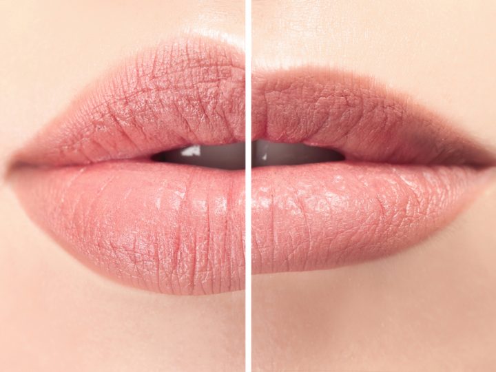 Thinning Lips: Why Lips Thin & 4 Ways to Improve Them
